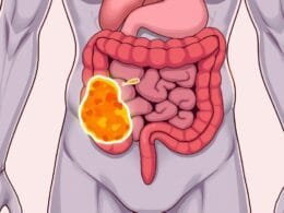 Can Diverticulitis Cause Back Pain? Find Out Here. 19 can diverticulitis cause back pain