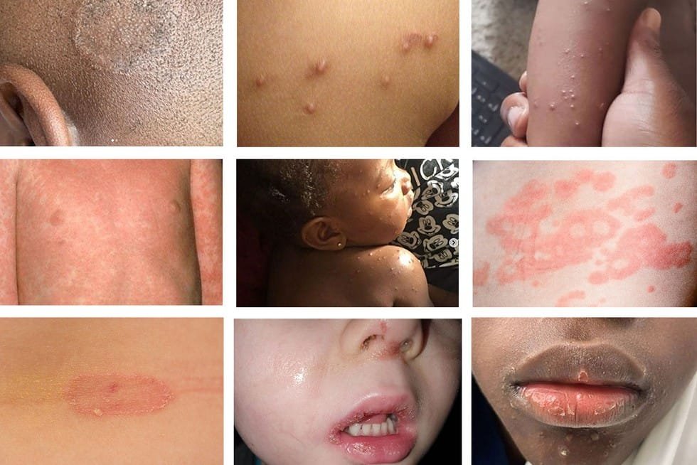 Common Baby Skin Conditions: What Parents Should Know